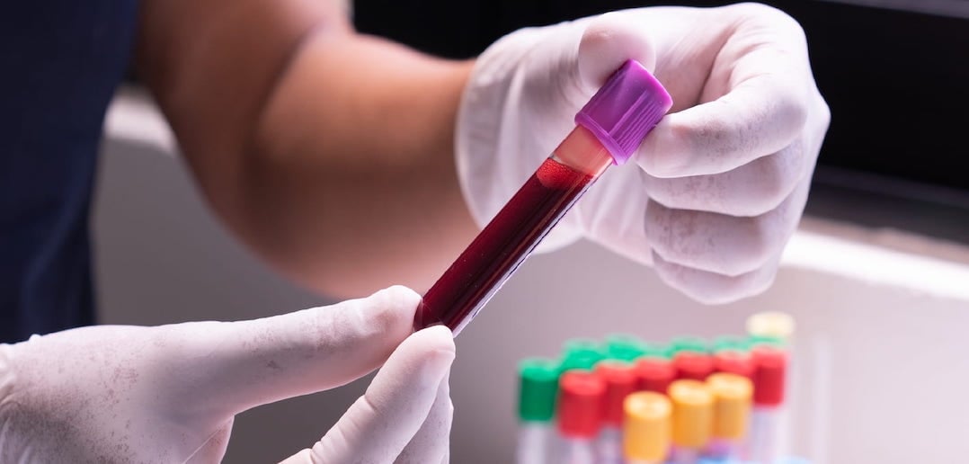 Scientists in Australia develop blood test to predict head, neck cancer relapse