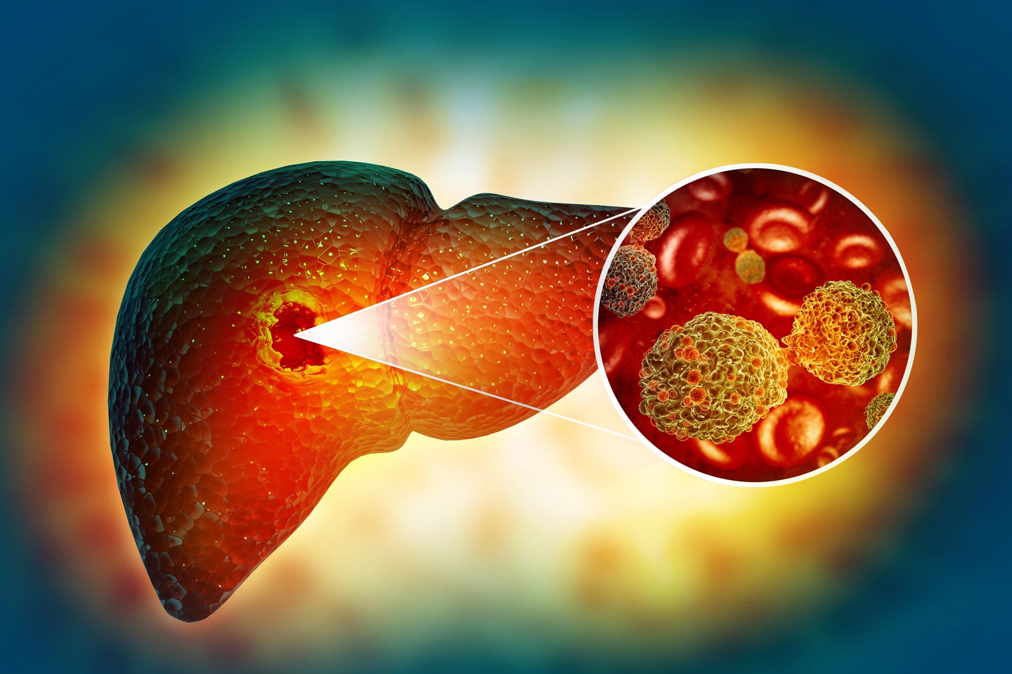 Potential fatty liver treatment may increase risk of cancer
