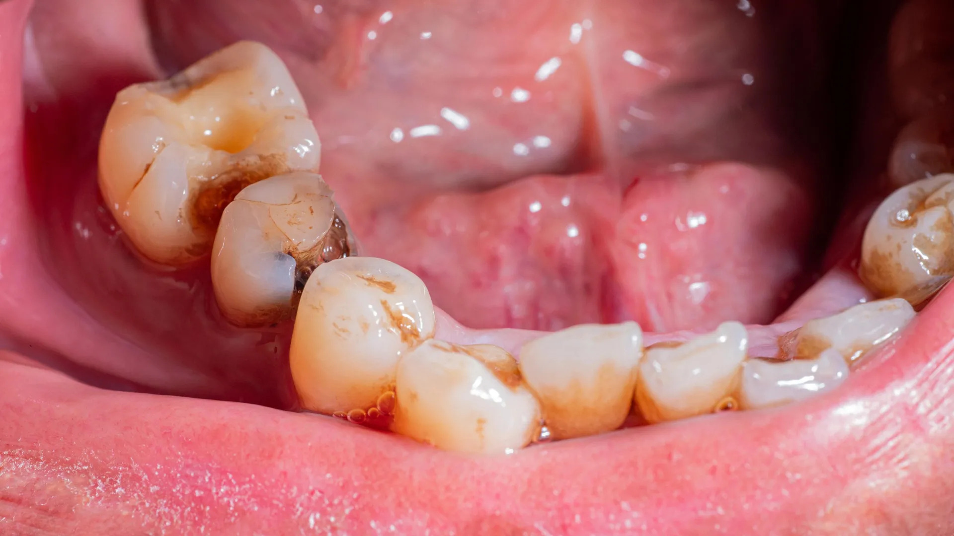 Fixing tooth infections can improve blood sugar and heart health: new study reveals