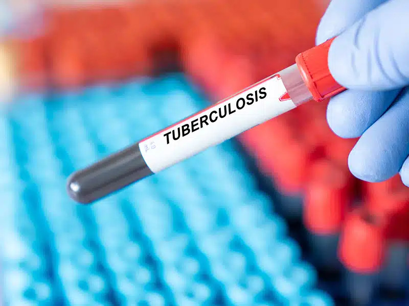 Rwanda cuts tuberculosis prevalence by over 70% since 2000
