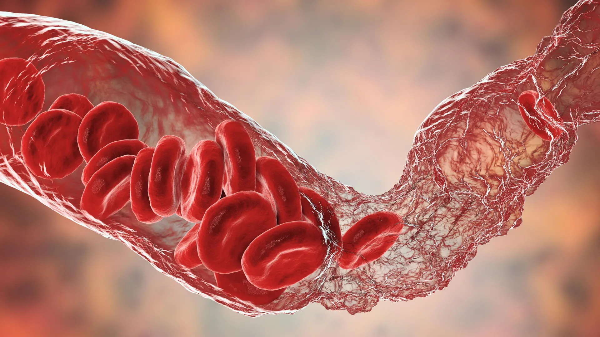 Breakthrough in  understanding  rare  blood  clotting  after COVID-19 vaccines